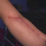 Brasil: Mulher vai a hospital no Rio para dar à luz e sai com mão amputada