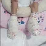 Morre bebê que teve pés queimados após hospital esquecer aquecedor ligado em Jacareí, SP