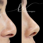 Bioplastia nasal é na Spazen Saúde e Beleza