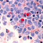 SUS estuda adoção de tratamento promissor contra câncer