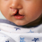 Programa ‘MS Saúde – Mais Saúde, Menos Fila’ realiza primeira cirurgia de correção de fissura lábio-palatal