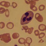 SUS oferece novo medicamento para pacientes com anemia por deficiência de ferro