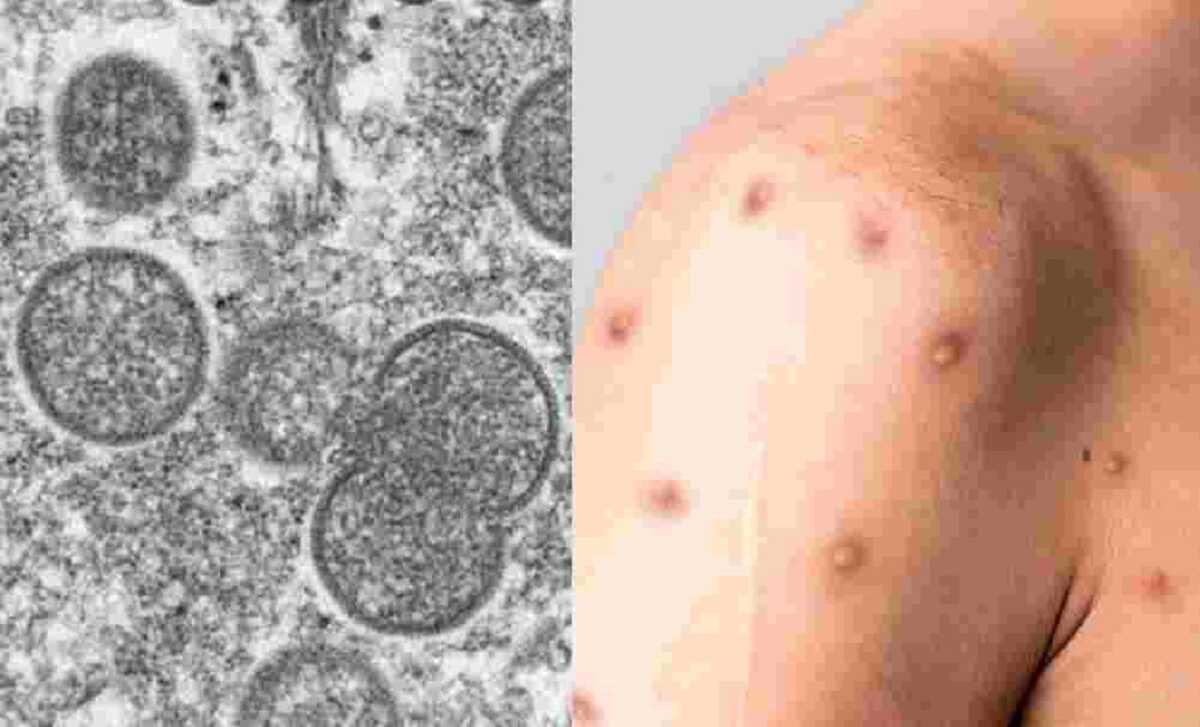 Mpox exige atenção para prevenção e tratamento