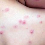 OMS convoca comitê para reavaliar emergência global por mpox