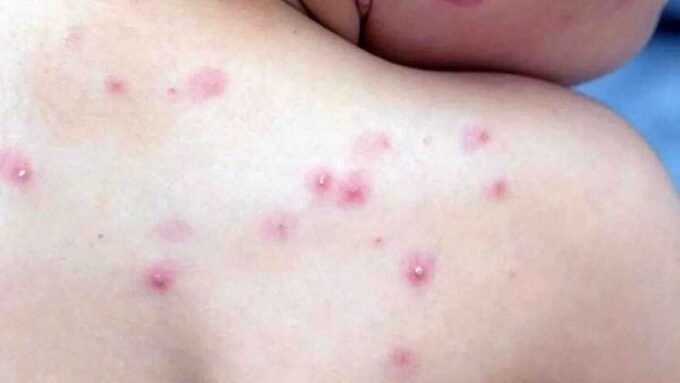 OMS convoca comitê para reavaliar emergência global por mpox