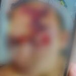 Jovem é espancado em confraternização e fica com rosto desfigurado em Sidrolândia