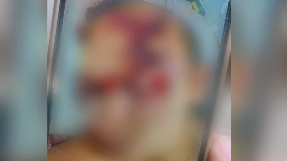 Jovem é espancado em confraternização e fica com rosto desfigurado em Sidrolândia