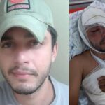 Homem atacado com água fervente recebe alta e fará tratamento para recuperar visão