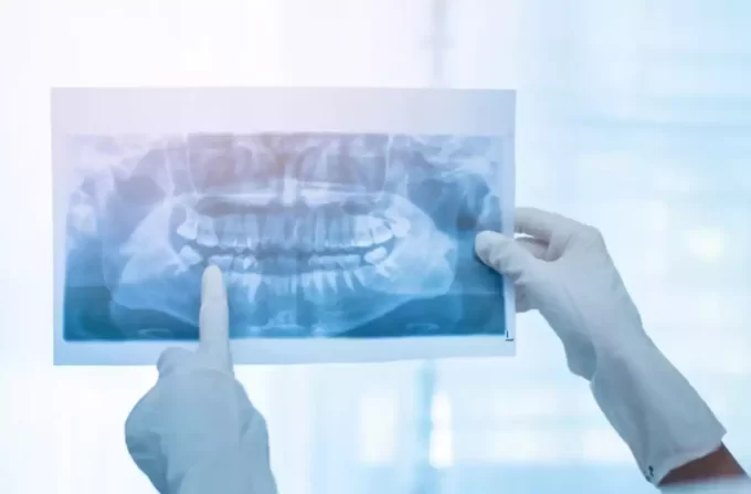 Dez municípios de MS devem ter raio-X panorâmico odontológico