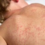 SES intensifica busca por casos suspeitos de sarampo e rubéola em MS