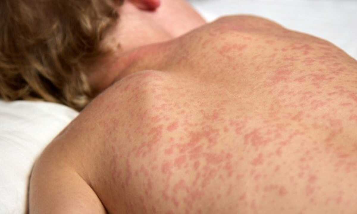 SES intensifica busca por casos suspeitos de sarampo e rubéola em MS