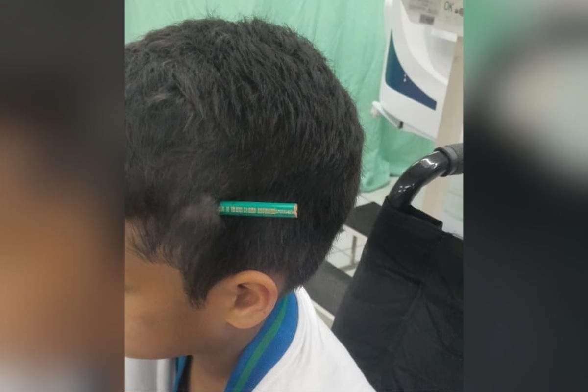Menino tem lápis fincado na cabeça após agressão de colega em escola
