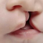 Exame para detectar fissura palatina será obrigatório em MS