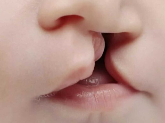 Exame para detectar fissura palatina será obrigatório em MS