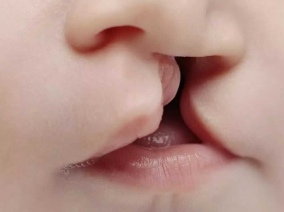 Exame para detectar fissura palatina será obrigatório em MS