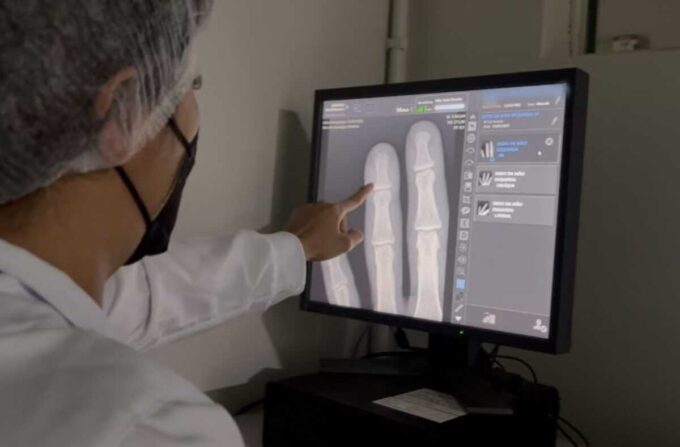 Novos aparelhos de raio-x ampliam em mais de 600 exames mensais em MS