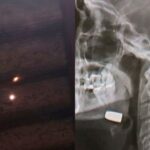 Homem é atingido por bala perdida no queixo enquanto dormia em Sidrolândia