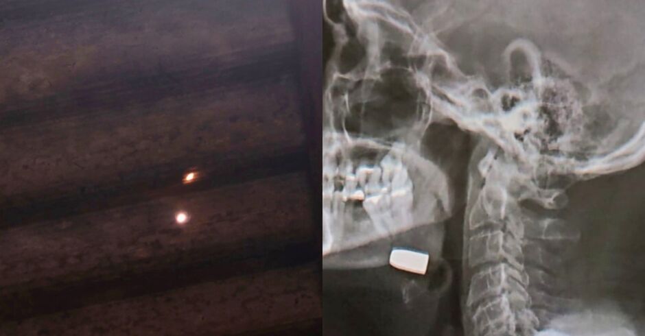 Homem é atingido por bala perdida no queixo enquanto dormia em Sidrolândia