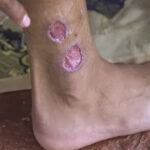 Mato Grosso do Sul já confirmou 120 casos de leishmaniose neste ano