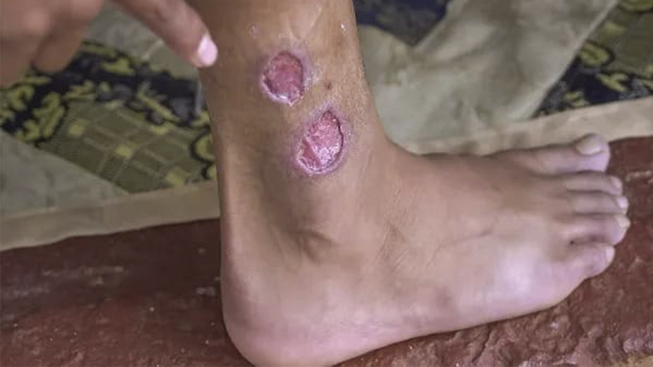 Mato Grosso do Sul já confirmou 120 casos de leishmaniose neste ano