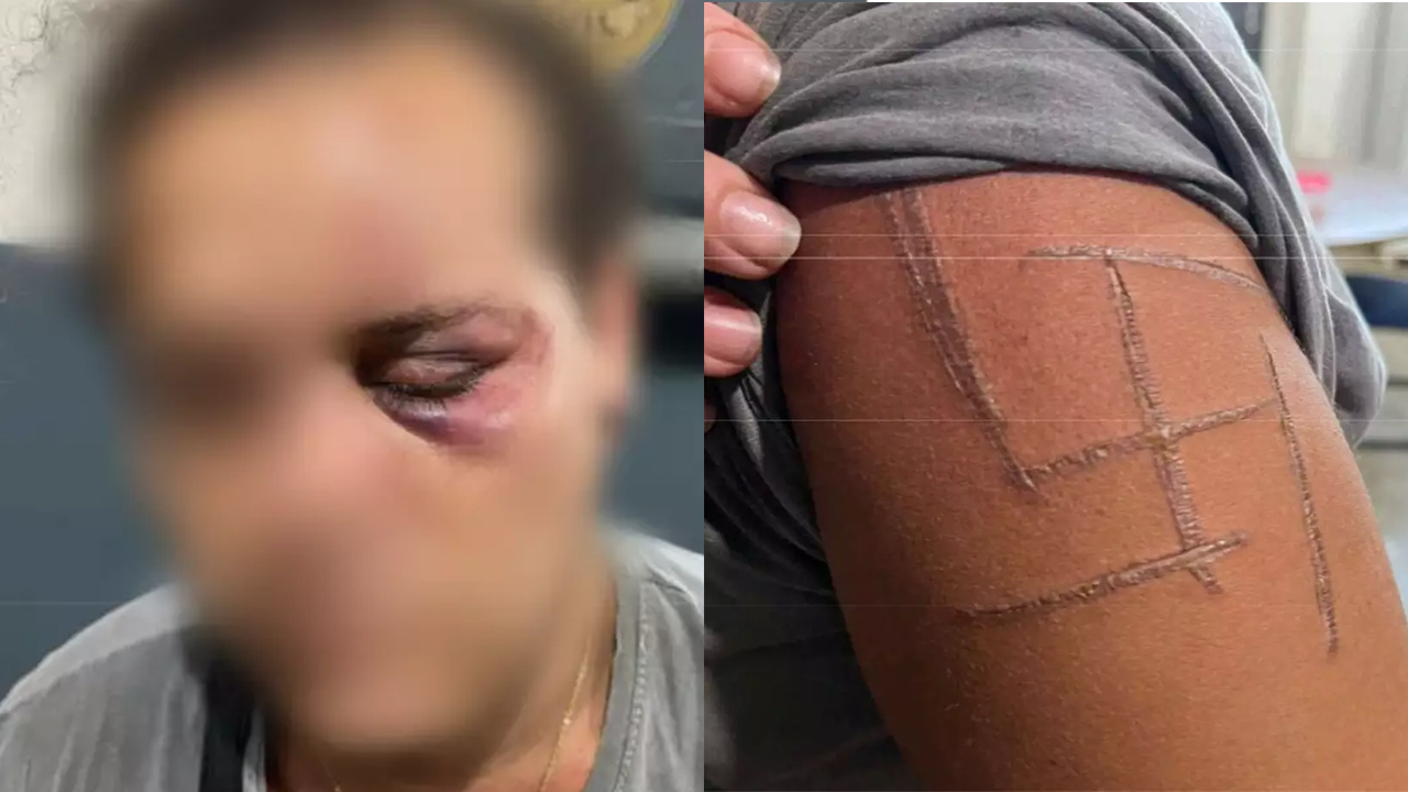 “Achei que iam me matar”, diz mulher trans espancada e marcada com suástica